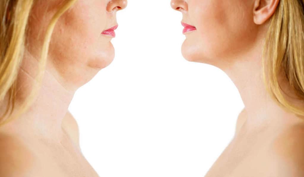 Double Chin treatment Marlow before and after results