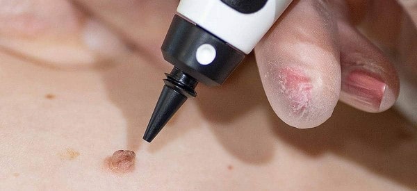 After Skin Tag Removal Marlow