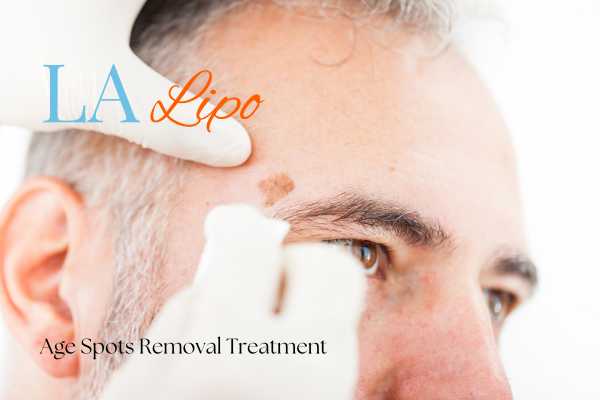 What Are the Most Effective Treatments for Age Spots Marlow?