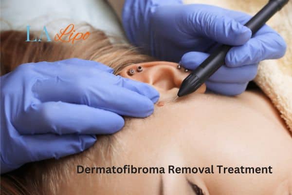 Dermatofibroma Removal Treatment Marlow