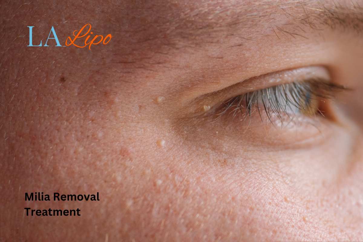 Cryopen Milia Removal: Is It the Easiest and Safest Option Marlow?