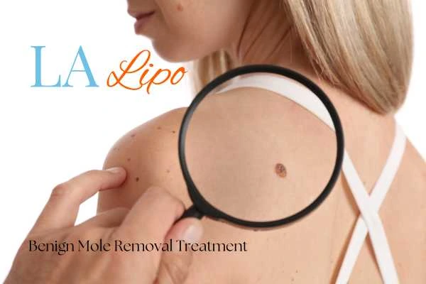Woman having her inspection of blemish before mole removal Marlow