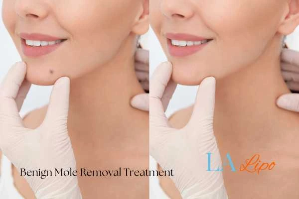 woman's before and after mole removal Marlow results