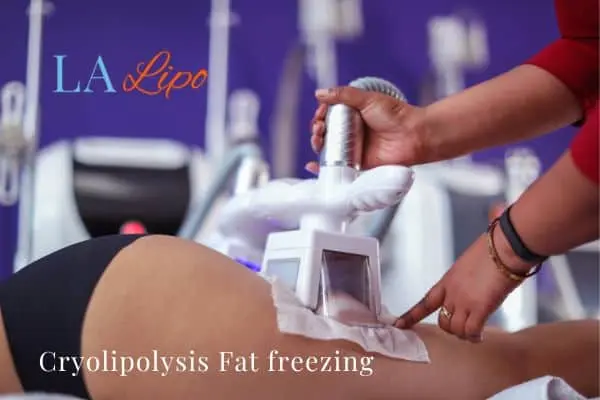 women getting fat freezing Marlow