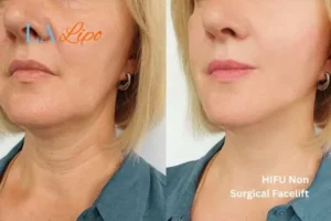 hi-fu for wrinkles Marlow before and after results