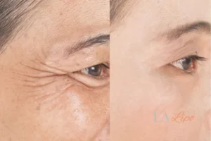 Before and after results of woman - HI-fu wrinkles reduction treatment Marlow