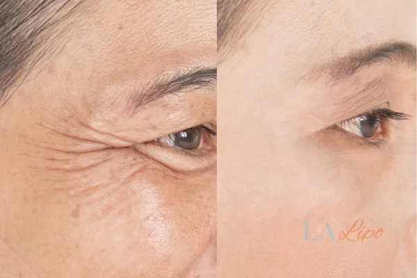 Before and after results of woman - HI-fu wrinkles reduction treatment Marlow