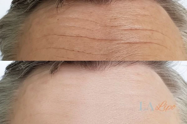 results of HIFU Marlow on mans forehead to help reduce lines and wrinkles
