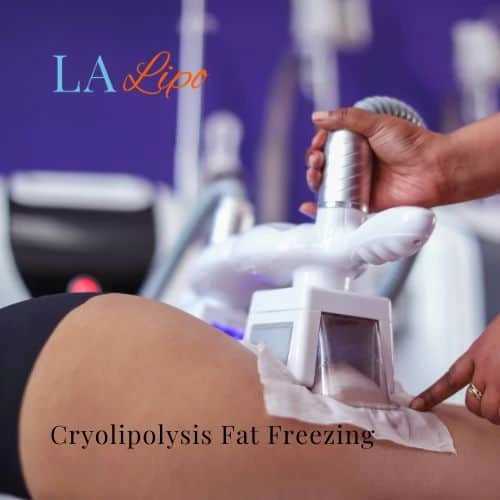 fat freezing - Cryolipolysis Marlow