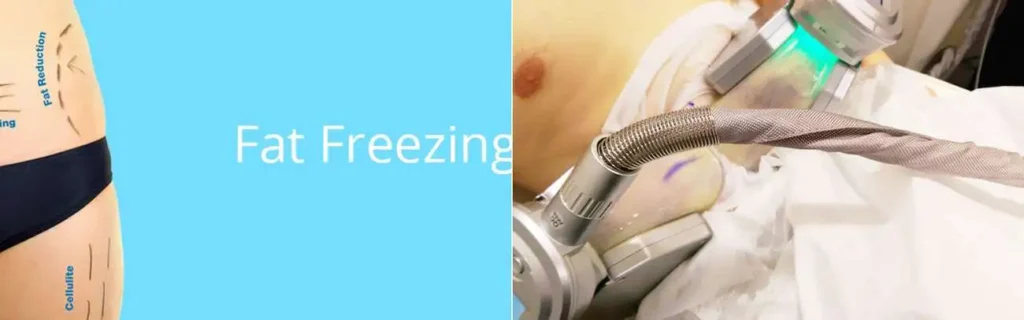Fat freezing Marlow on multiple areas of the body