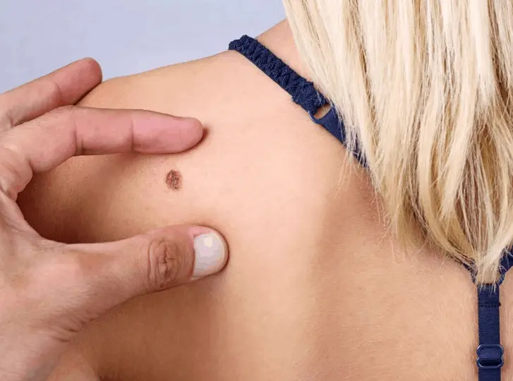 woman having mole removal Marlow consultation before treatment.