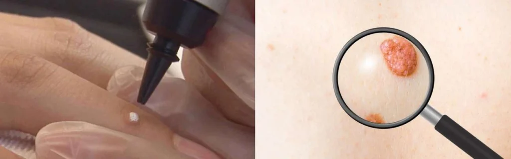 Person getting moles removed with cryopen Marlow