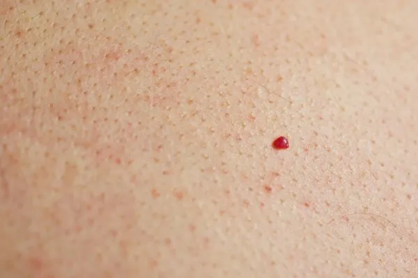 close up of a cherry angioma Marlow