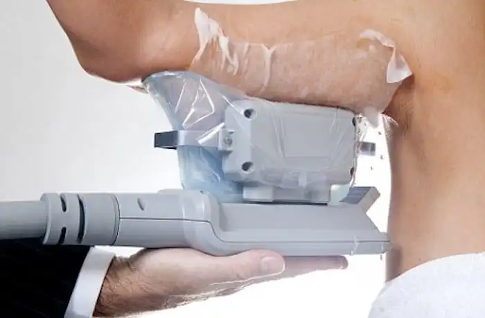 Picture of fat freezing Marlow on the upper arms.