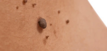image of a skin tag Marlow