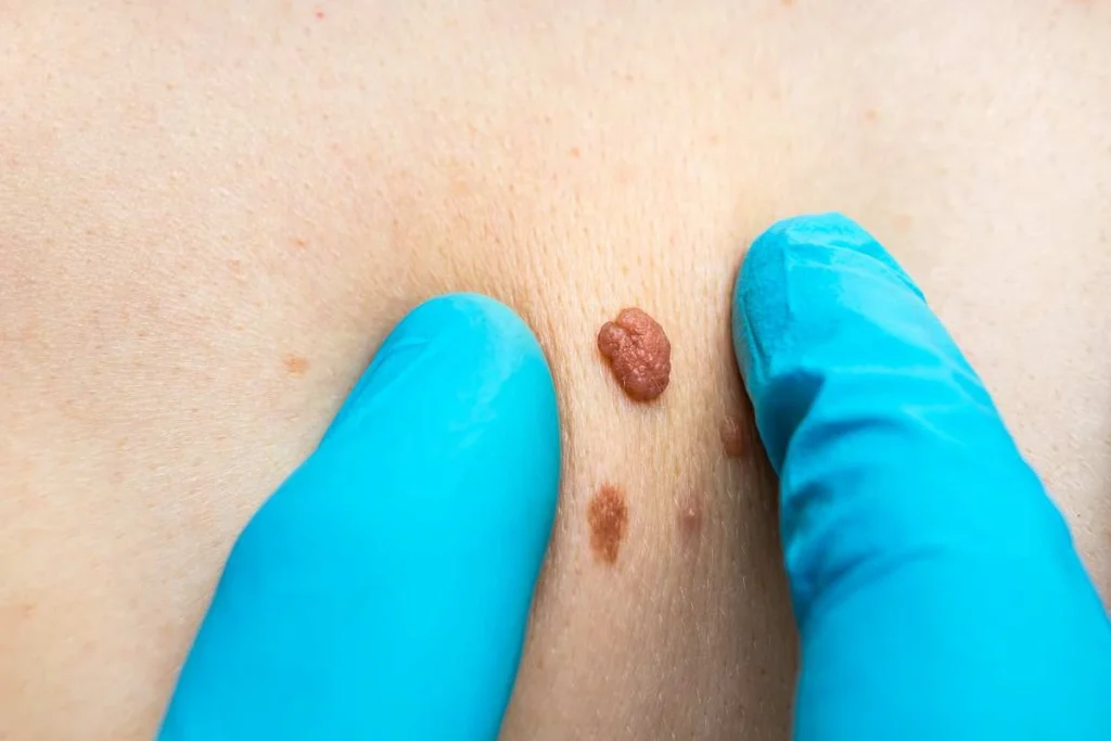 Consultant examining a skin tag Marlow