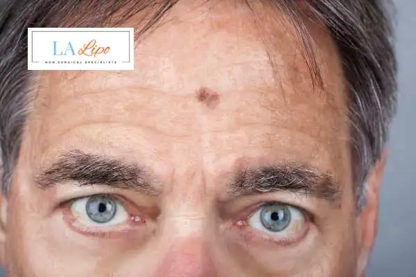 Solar Lentigo Removal Marlow image of man with mark on his forehead