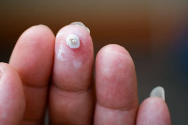 wart on person finger - cryotherapy to treat from LA LIPO Marlow