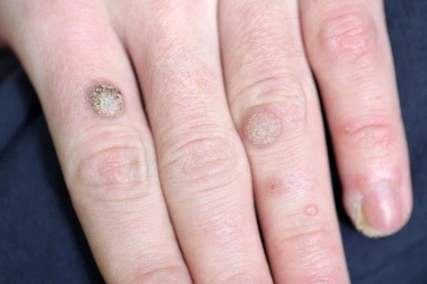 photo of warts on person hand - see wart removal Marlow from LA LIPO