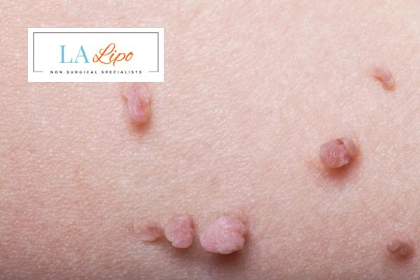 Does cryopen skin tag removal Marlow hurt? Find out now call our team today!