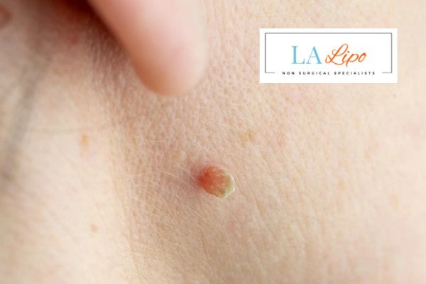 Book skin tag removal Marlow today speak to our team now!
