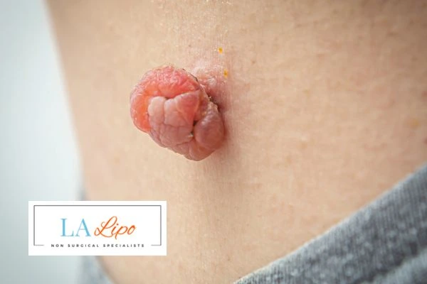 Interested in skin tag removal Marlow? Concerned about the pain? Find out more today!