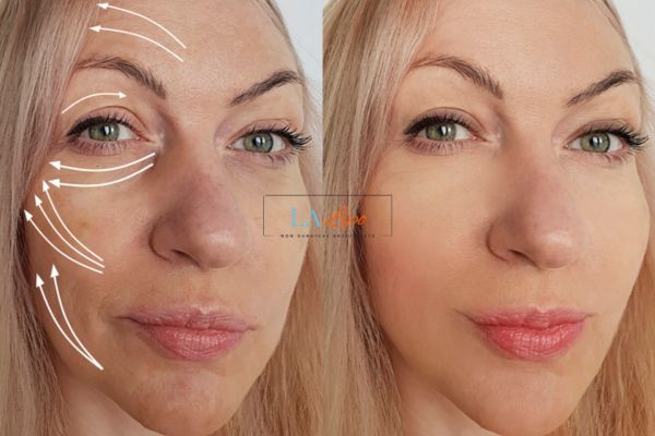 Morpheus 8 results Marlow face lift.