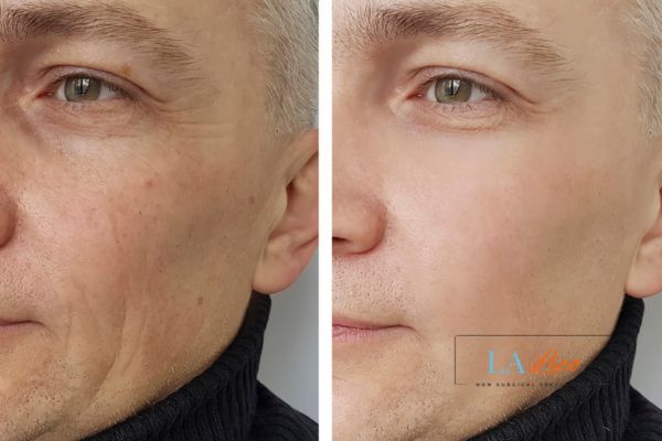 See the amazing results of Morpheus8 Treatment Marlow!