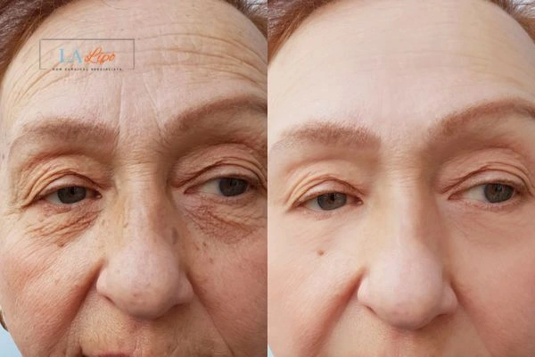 The powerful benefits of Morpheus8 Treatment Marlow - Call Our team today!