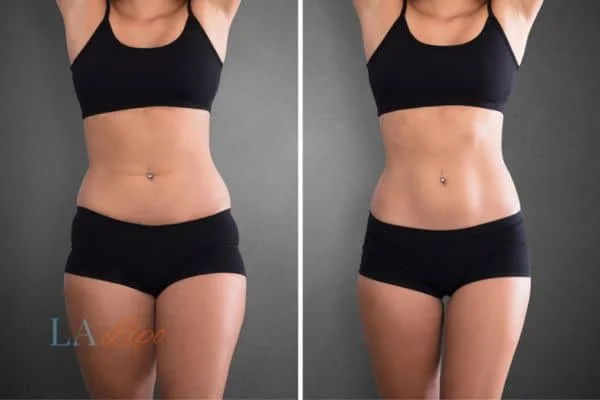 before and after results of non-surgical treatment to help a woman's body image and mental health Marlow