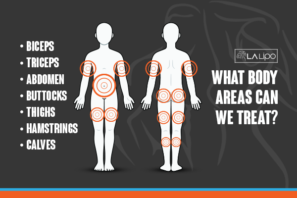 Diagram to show areas you can have LA-EMS Body Sculpting Treatment Marlow