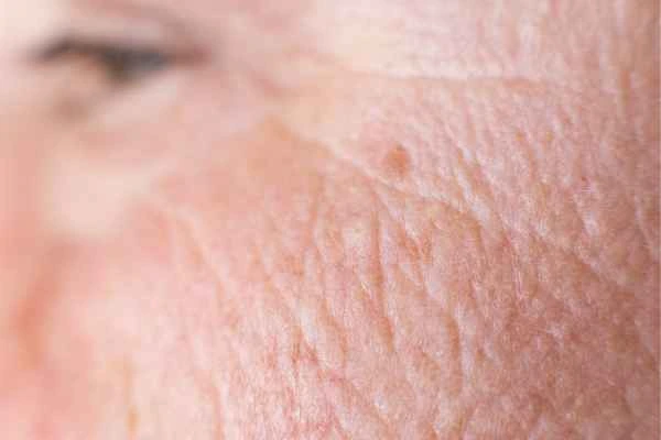 close up picture of a woman's face showing an age spot Marlow