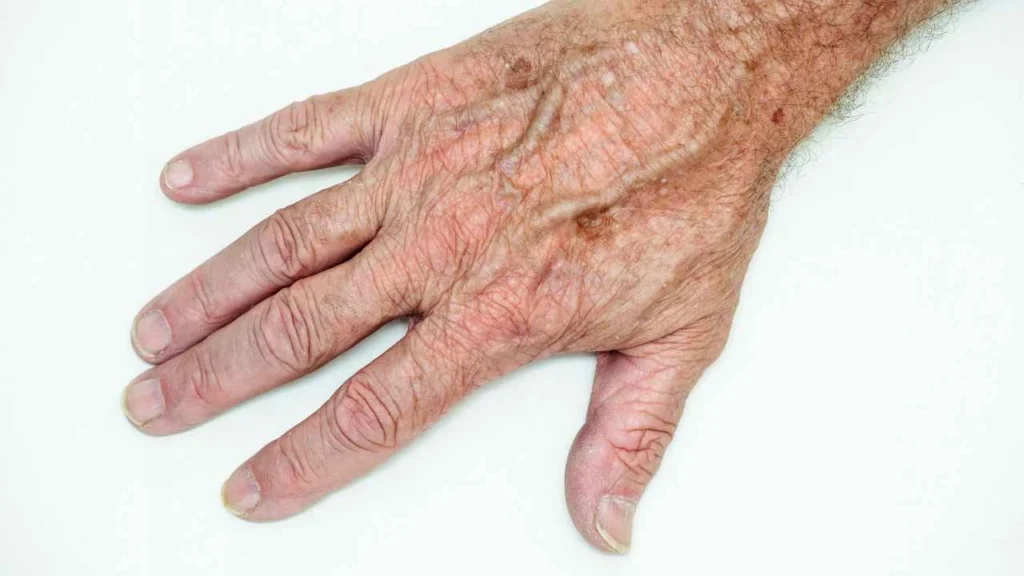 Male hand showing age spot Marlow