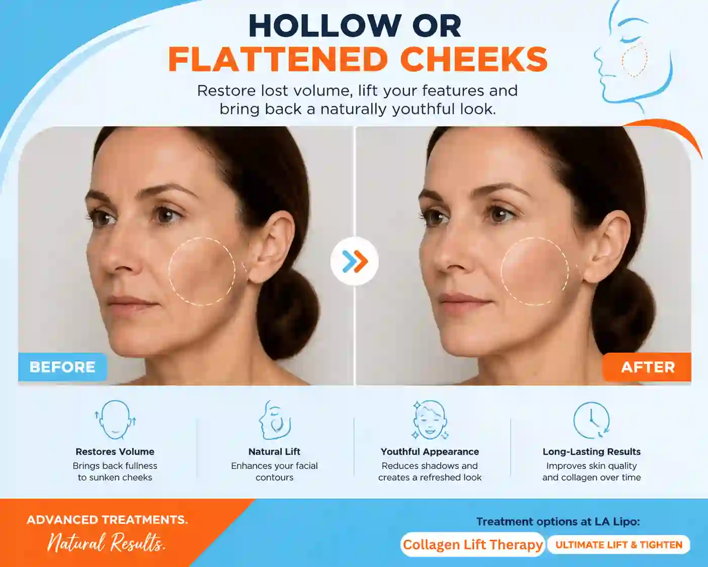 Sign #4: Hollow or Flattened Cheeks Marlow