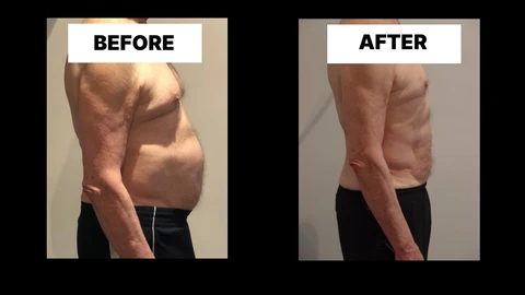 What Symptoms Can Diastasis Recti Cause in Men? Weak Core, Back Pain and Poor Posture Marlow